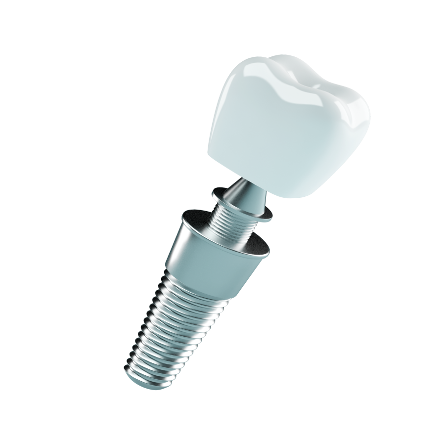 Dental Implants - Image 2